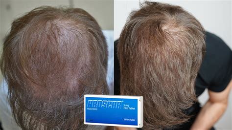finasteride one year results.